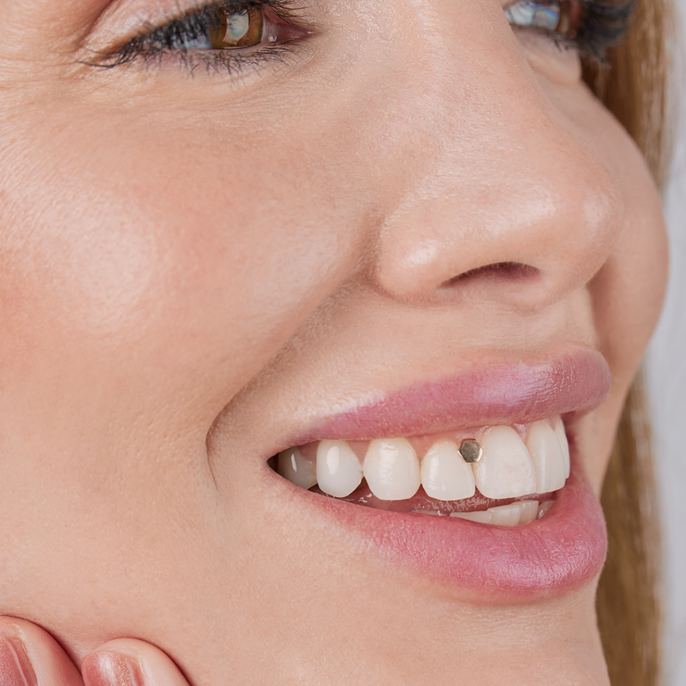 Milyen mosolyékszer illik hozzád?